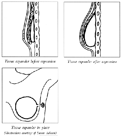 Breast Implantation